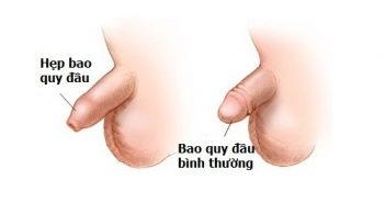 Chữa trị hẹp bao quy đầu nhanh khỏi như thế nào? hẹp bao quy đầu