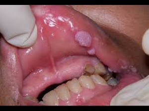 Biểu hiện của bệnh sùi mào gà ở miệng